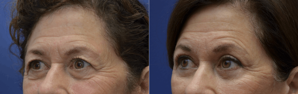Brow Lift (Forehead Lift) Before & After Gallery - Patient 399334 - Image 3