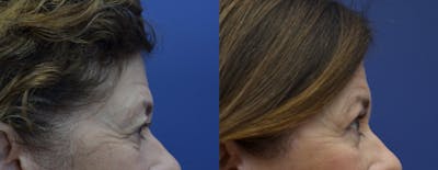 Brow Lift (Forehead Lift) Before & After Gallery - Patient 399334 - Image 4