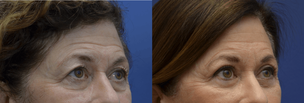 Brow Lift (Forehead Lift) Before & After Gallery - Patient 399334 - Image 5