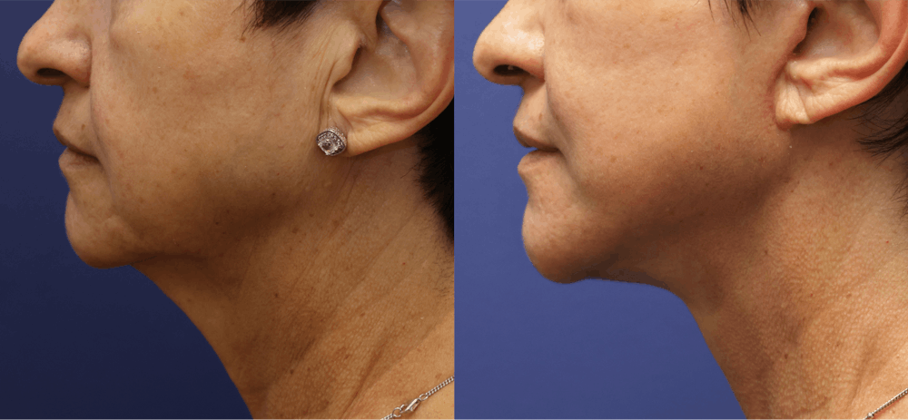 Deep Plane Neck Lift Before & After Gallery - Patient 278043 - Image 3