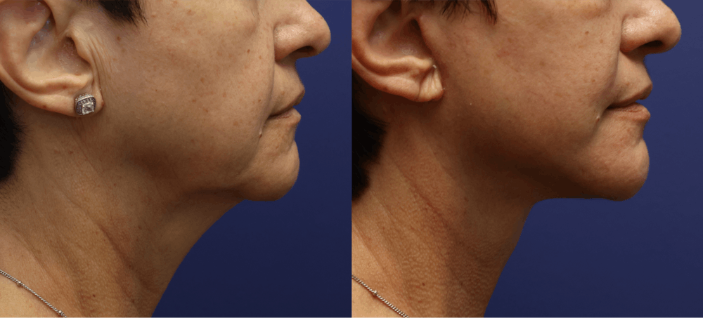 Deep Plane Facelift Before & After Gallery - Patient 396808 - Image 2