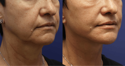 Deep Plane Neck Lift Before & After Gallery - Patient 278043 - Image 1
