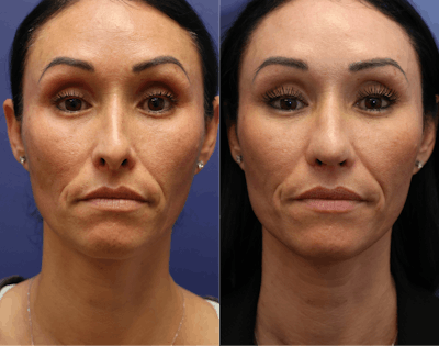 Rhinoplasty (Nose Reshaping) Before & After Gallery - Patient 127130 - Image 2