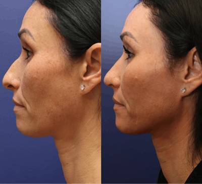 Rhinoplasty (Nose Reshaping) Before & After Gallery - Patient 127130 - Image 1