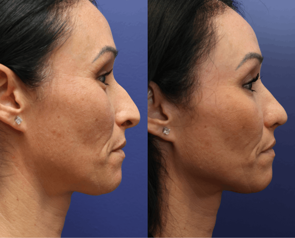 Rhinoplasty (Nose Reshaping) Before & After Gallery - Patient 127130 - Image 4