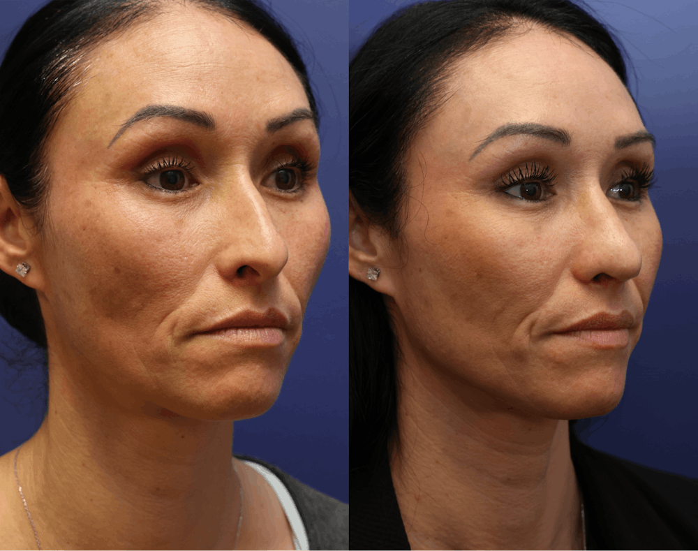 Rhinoplasty (Nose Reshaping) Before & After Gallery - Patient 127130 - Image 5