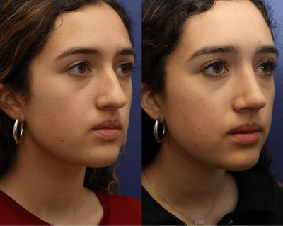 Rhinoplasty (Nose Reshaping) Before & After Gallery - Patient 409691 - Image 2