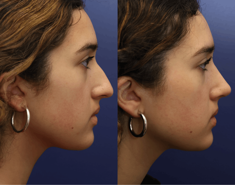 Rhinoplasty (Nose Reshaping) Before & After Gallery - Patient 409691 - Image 1