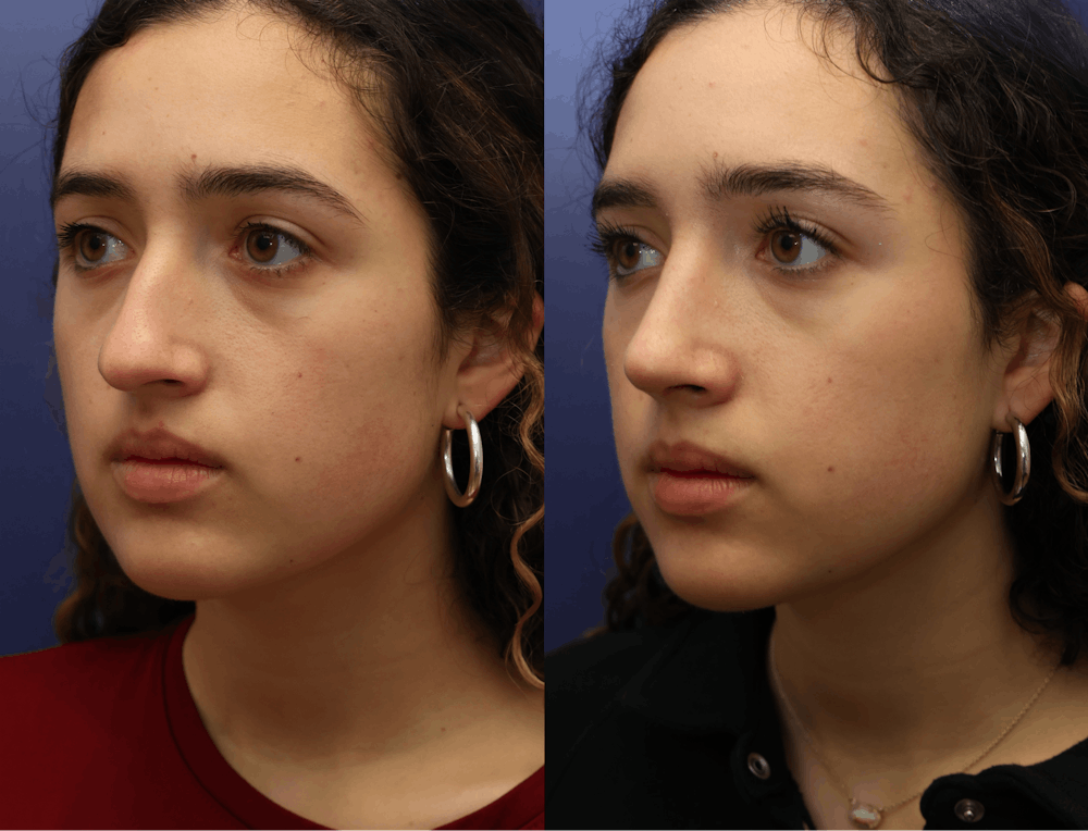 Rhinoplasty (Nose Reshaping) Before & After Gallery - Patient 409691 - Image 4