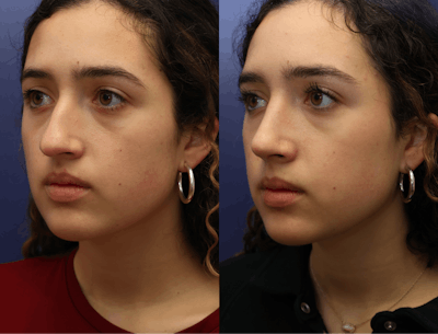 Rhinoplasty (Nose Reshaping) Before & After Gallery - Patient 409691 - Image 4