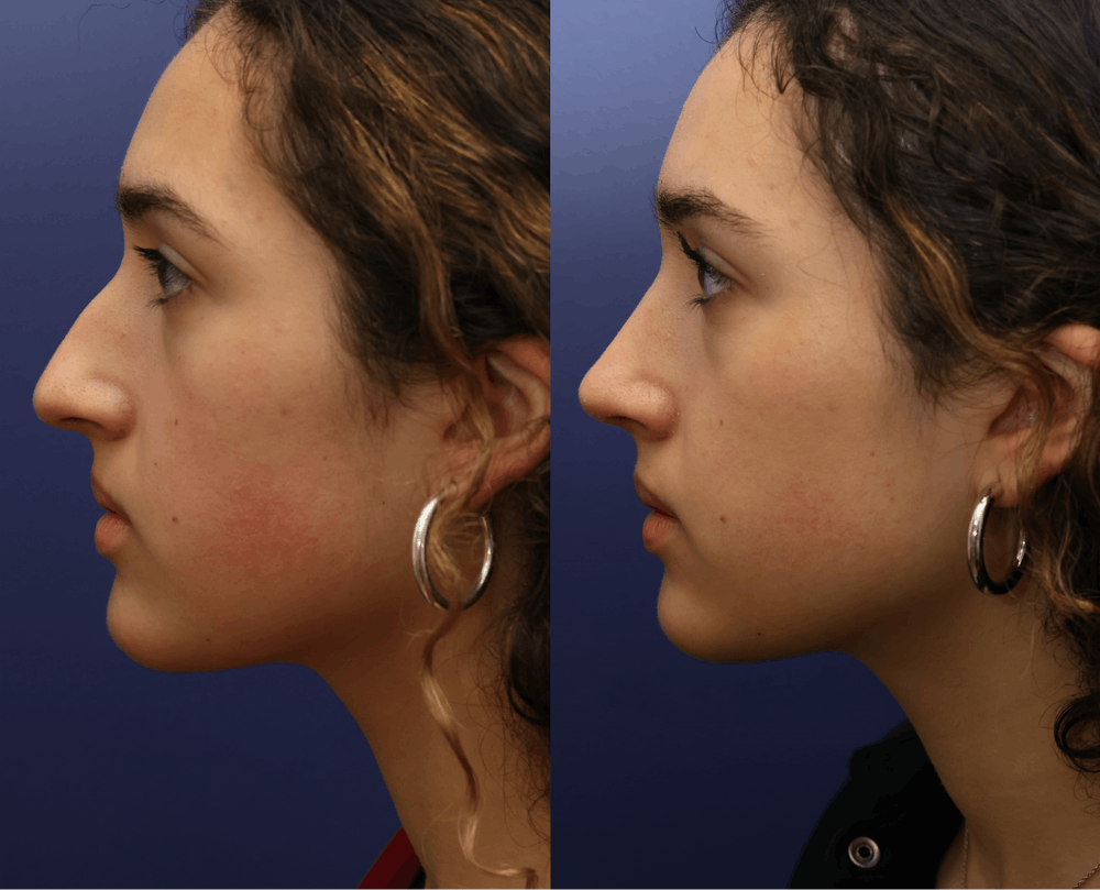 Rhinoplasty (Nose Reshaping) Before & After Gallery - Patient 409691 - Image 3