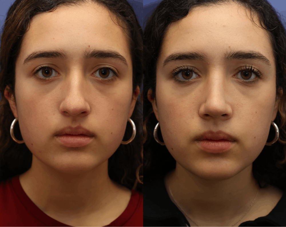 Rhinoplasty (Nose Reshaping) Before & After Gallery - Patient 409691 - Image 5