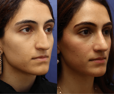Rhinoplasty (Nose Reshaping) Before & After Gallery - Patient 464481 - Image 2