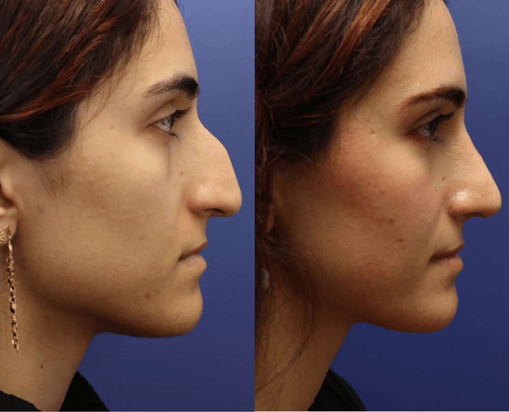 Rhinoplasty (Nose Reshaping) Before & After Gallery - Patient 464481 - Image 5