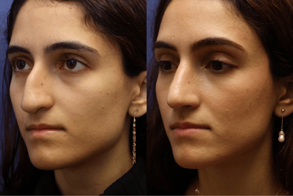 Rhinoplasty (Nose Reshaping) Before & After Gallery - Patient 464481 - Image 3