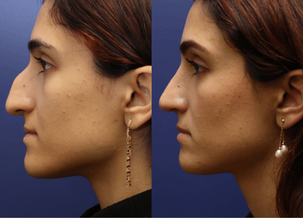 Rhinoplasty (Nose Reshaping) Before & After Gallery - Patient 464481 - Image 1