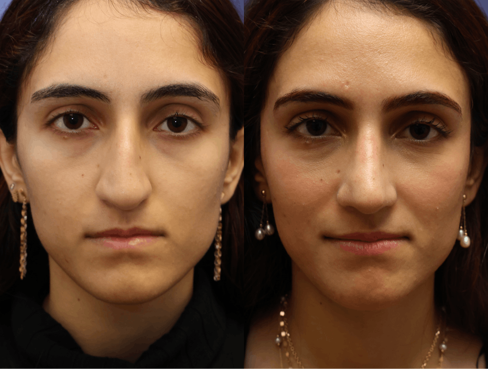 Rhinoplasty (Nose Reshaping) Before & After Gallery - Patient 464481 - Image 4