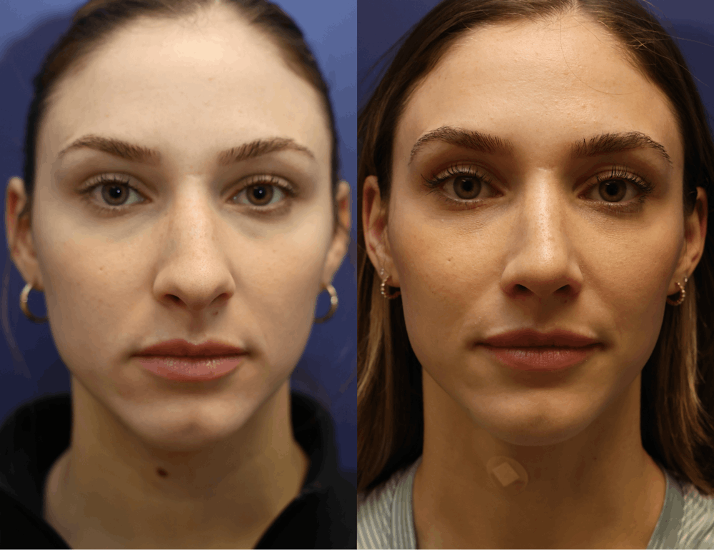 Rhinoplasty (Nose Reshaping) Before & After Gallery - Patient 175171333 - Image 4