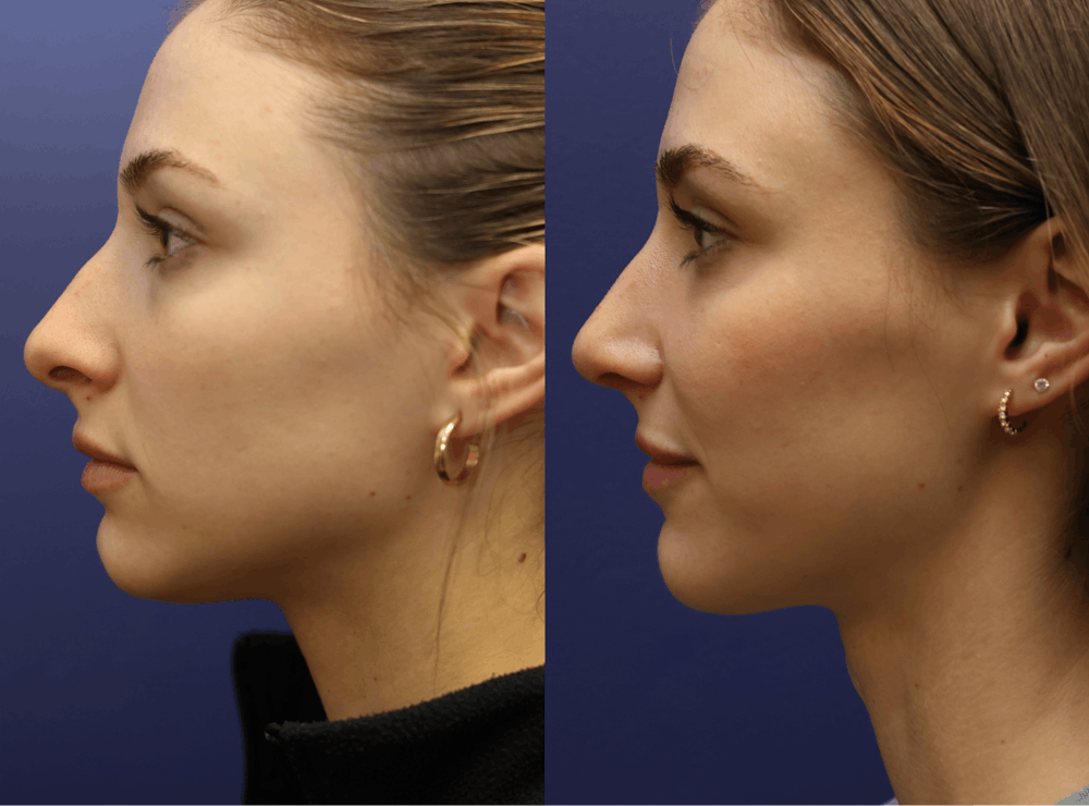 Rhinoplasty (Nose Reshaping) Before & After Gallery - Patient 175171333 - Image 3