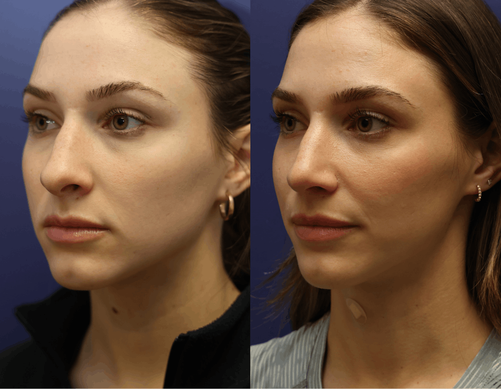 Rhinoplasty (Nose Reshaping) Before & After Gallery - Patient 175171333 - Image 2
