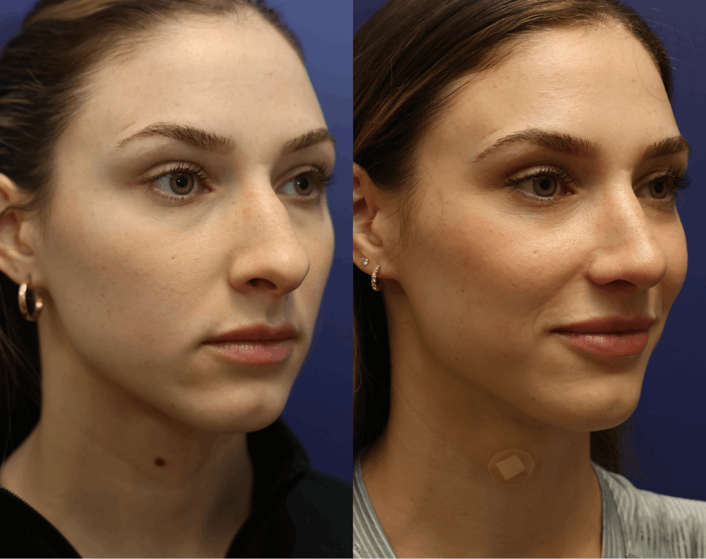 Rhinoplasty (Nose Reshaping) Before & After Gallery - Patient 175171333 - Image 1