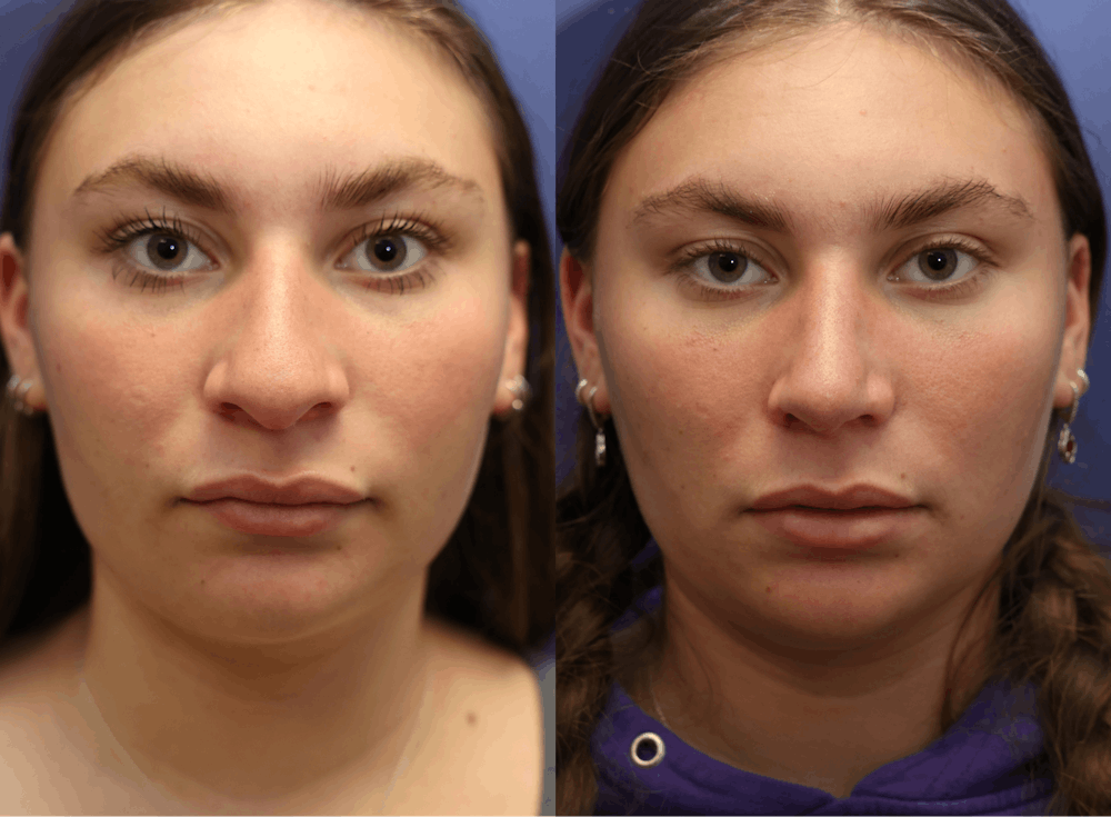 Rhinoplasty (Nose Reshaping) Before & After Gallery - Patient 197485 - Image 3