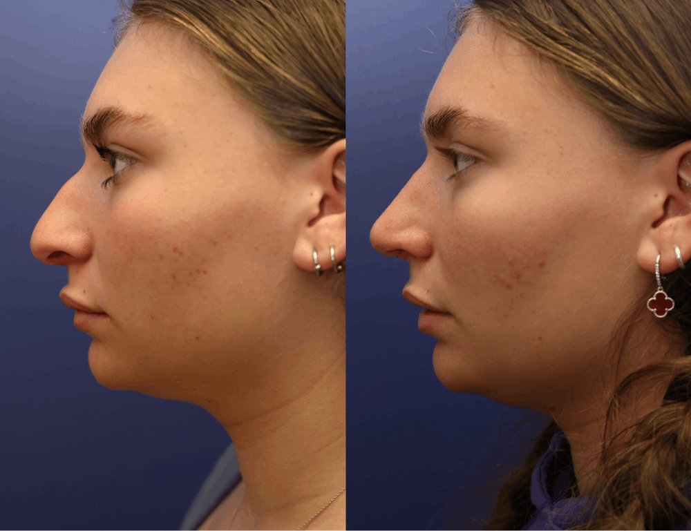 Rhinoplasty (Nose Reshaping) Before & After Gallery - Patient 197485 - Image 4
