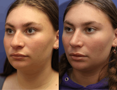 Rhinoplasty (Nose Reshaping) Before & After Gallery - Patient 197485 - Image 1