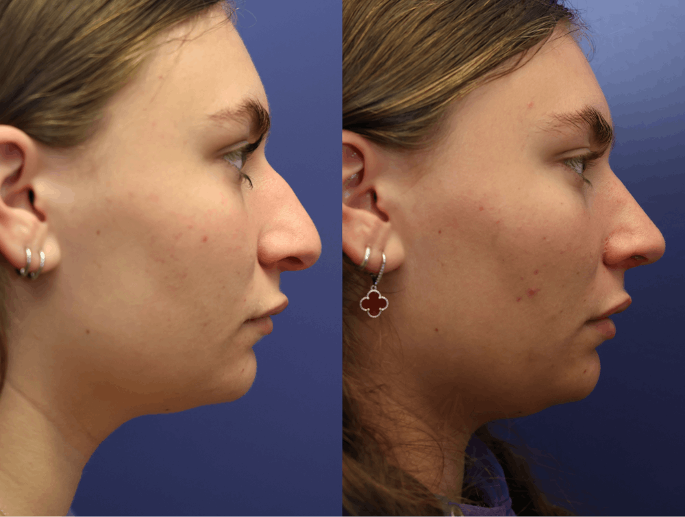 Rhinoplasty (Nose Reshaping) Before & After Gallery - Patient 197485 - Image 5
