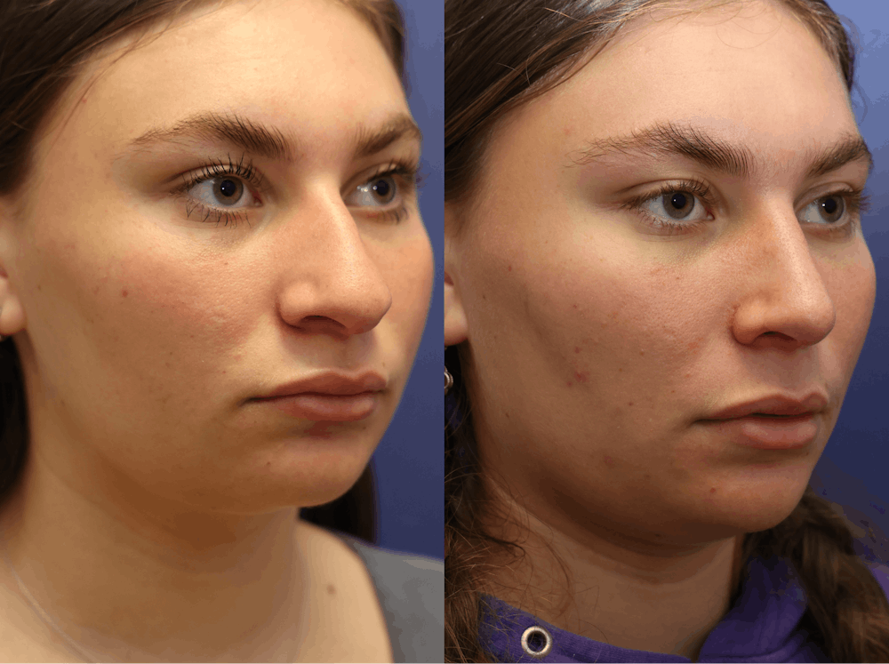 Rhinoplasty (Nose Reshaping) Before & After Gallery - Patient 197485 - Image 3