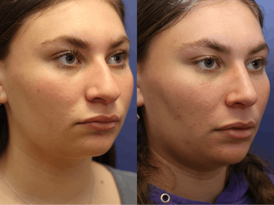 Rhinoplasty (Nose Reshaping) Before & After Gallery - Patient 197485 - Image 2