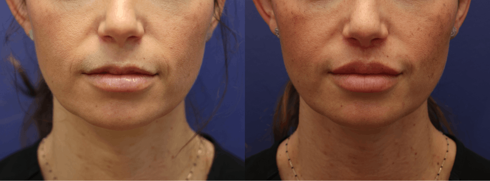 Lip Lift Before & After Gallery - Patient 119870 - Image 1