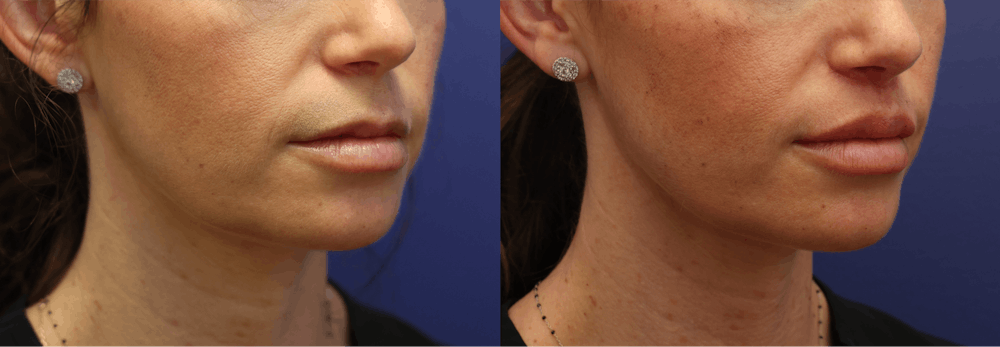 Lip Lift Before & After Gallery - Patient 119870 - Image 3