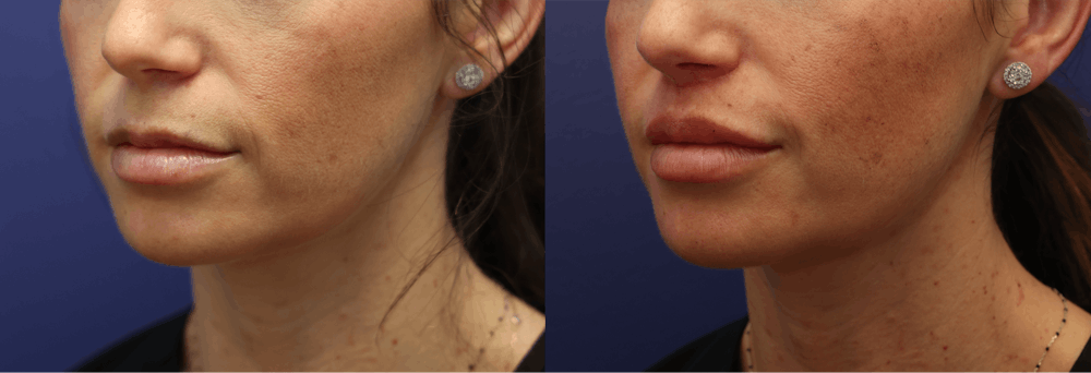 Lip Augmentation Before & After Gallery - Patient 312222 - Image 2