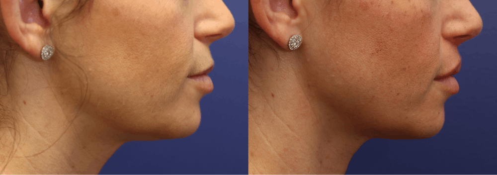 Lip Augmentation Before & After Gallery - Patient 312222 - Image 4