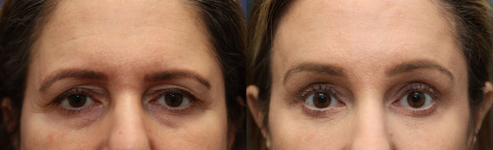 Brow Lift (Forehead Lift) Before & After Gallery - Patient 161307672 - Image 1