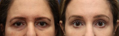 Brow Lift (Forehead Lift) Before & After Gallery - Patient 161307672 - Image 1