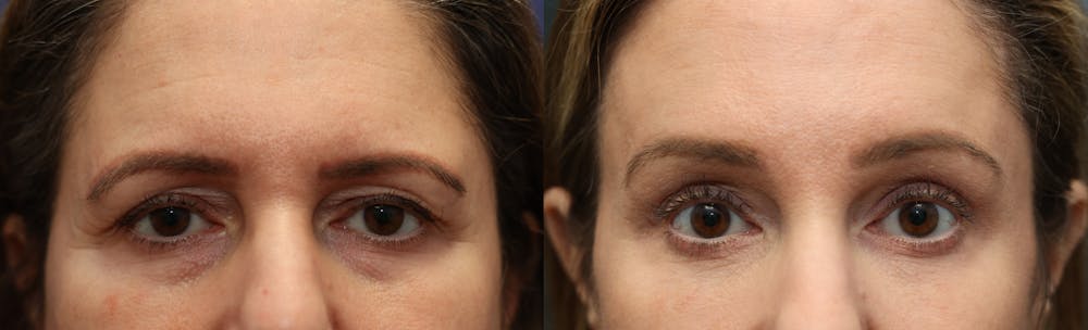 Eyelid Surgery Before & After Gallery - Patient 122171 - Image 1