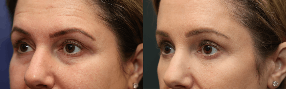 Brow Lift (Forehead Lift) Before & After Gallery - Patient 161307672 - Image 3