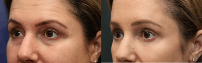 Eyelid Surgery Before & After Gallery - Patient 122171 - Image 2