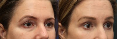 Brow Lift (Forehead Lift) Before & After Gallery - Patient 161307672 - Image 2