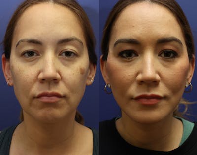 Deep Plane Neck Lift Before & After Gallery - Patient 114655 - Image 1