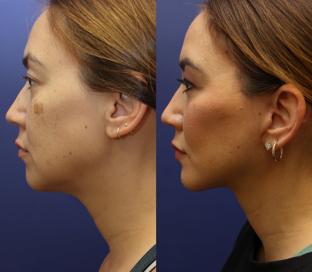 Deep Plane Neck Lift Before & After Gallery - Patient 114655 - Image 3