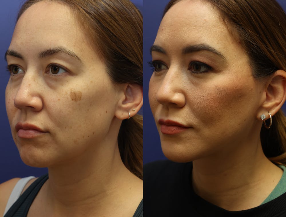 Deep Plane Neck Lift Before & After Gallery - Patient 114655 - Image 2