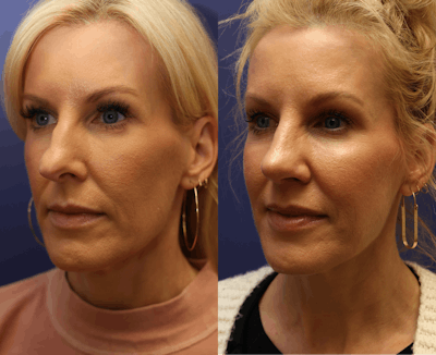 Rhinoplasty (Nose Reshaping) Before & After Gallery - Patient 161307698 - Image 2