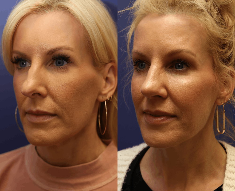 Rhinoplasty (Nose Reshaping) Before & After Gallery - Patient 161307698 - Image 2