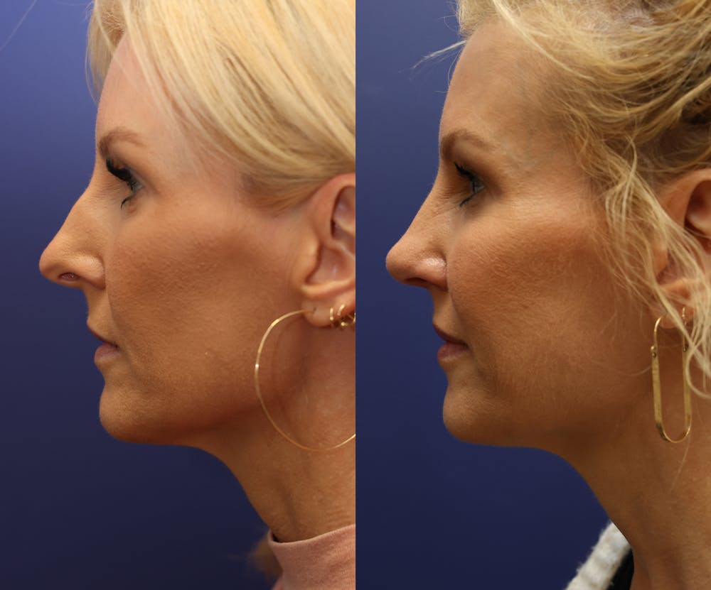 Rhinoplasty (Nose Reshaping) Before & After Gallery - Patient 161307698 - Image 4