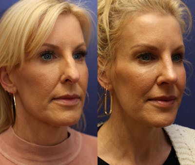 Rhinoplasty (Nose Reshaping) Before & After Gallery - Patient 161307698 - Image 1