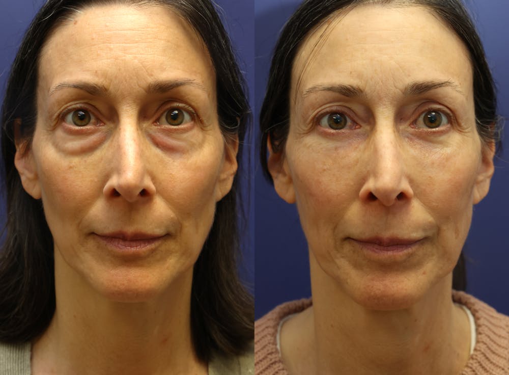 Facial Revolumizing (Fat Transfer) Before & After Gallery - Patient 391502 - Image 1