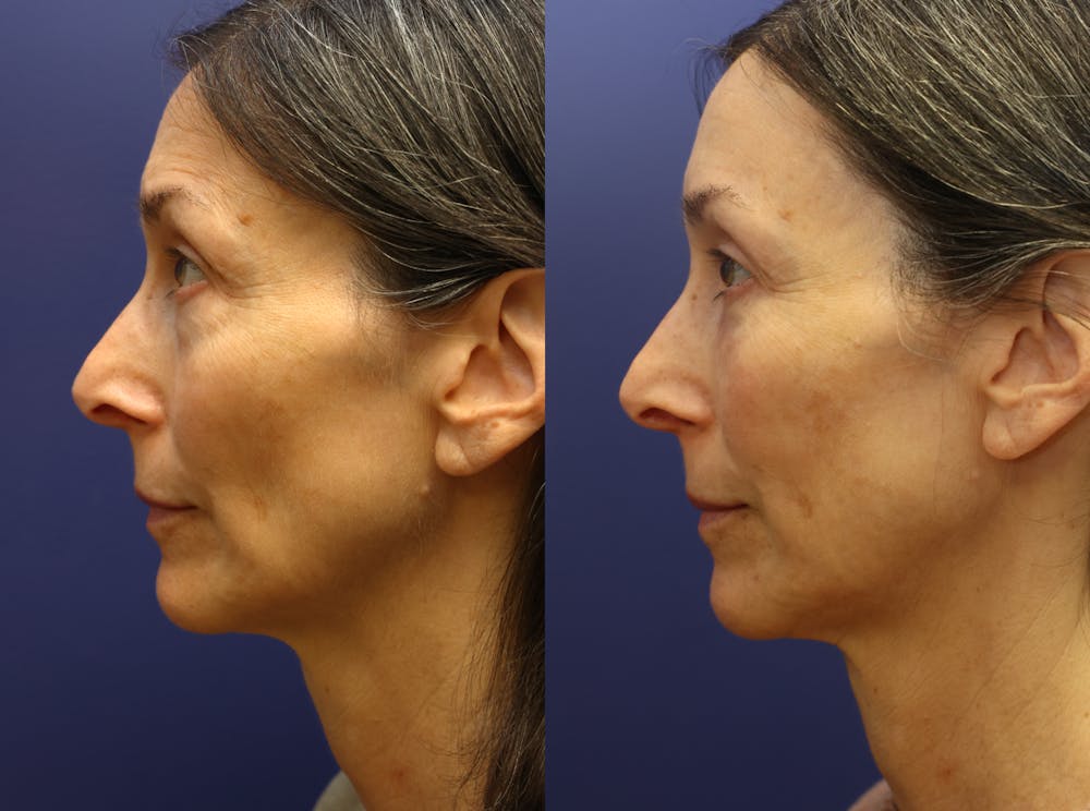 Eyelid Surgery Before & After Gallery - Patient 322159 - Image 3